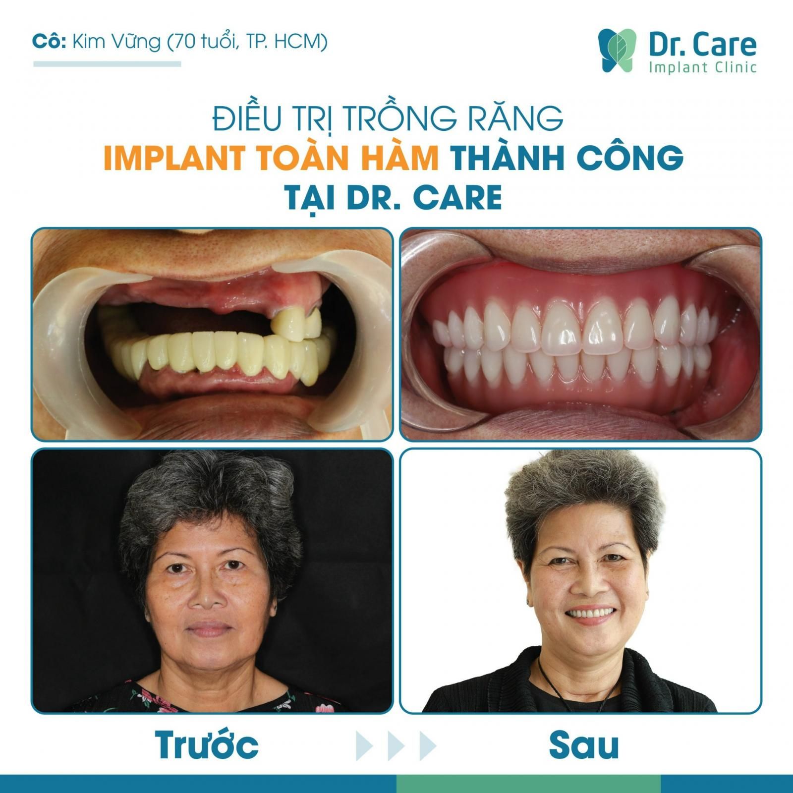 5 Lời dặn của Bác sĩ sau khi trồng răng Implant toàn hàm