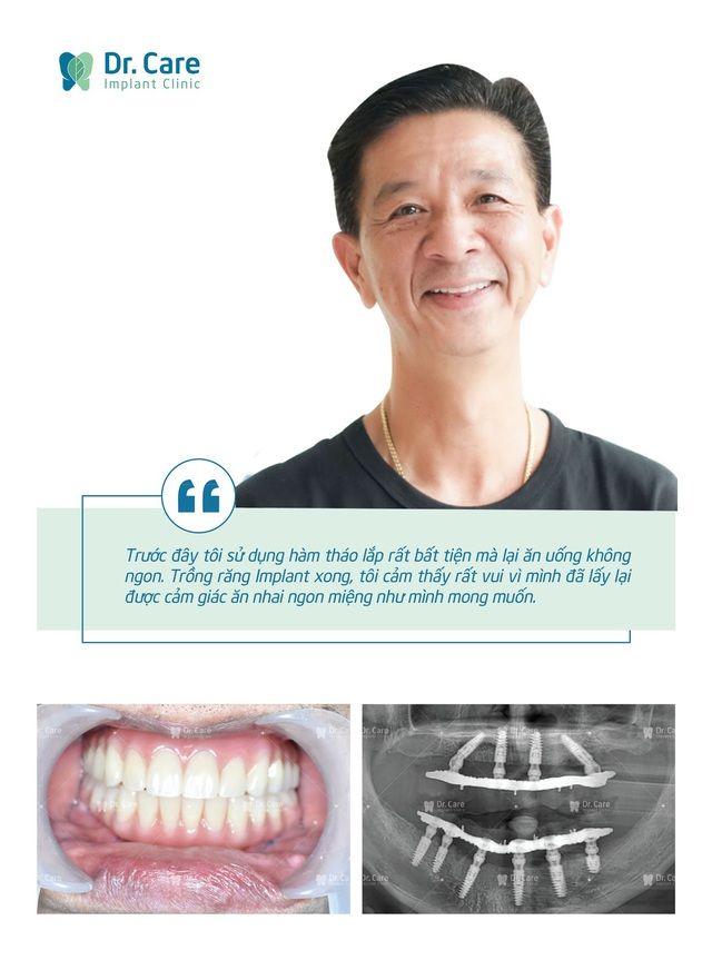 Ưu điểm trồng răng Implant toàn hàm 