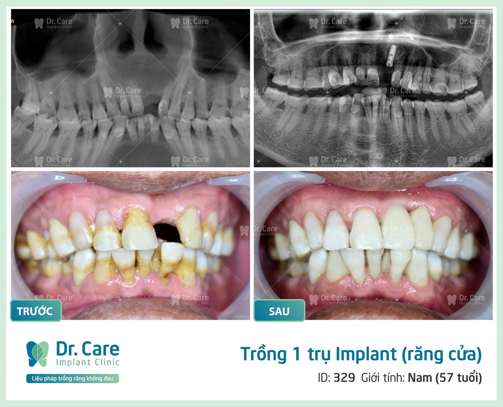 Trụ Implant Kontact có giảm tiêu xương không?