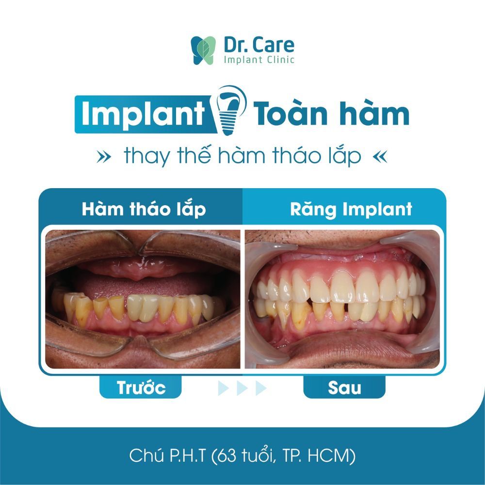 Các dịch vụ trồng răng Implant không đau tại Dr. Care