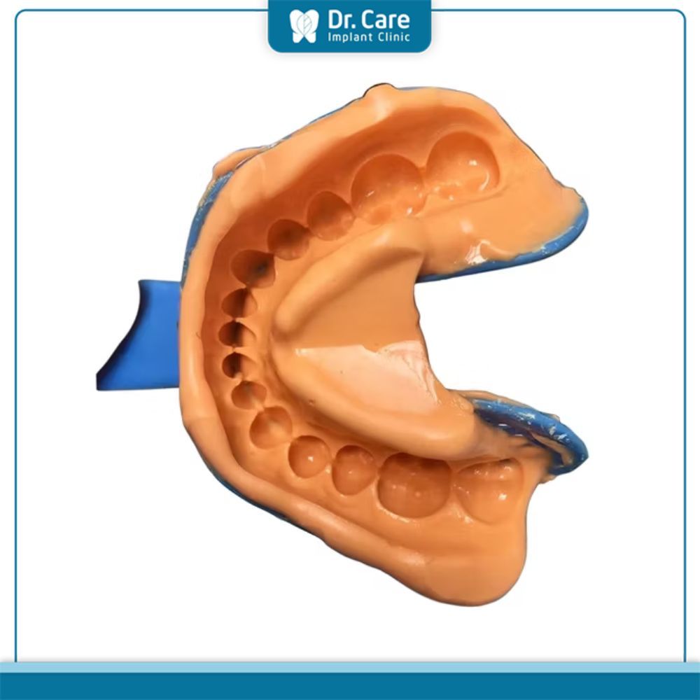 Ưu nhược điểm các phương pháp lấy dấu răng khi niềng