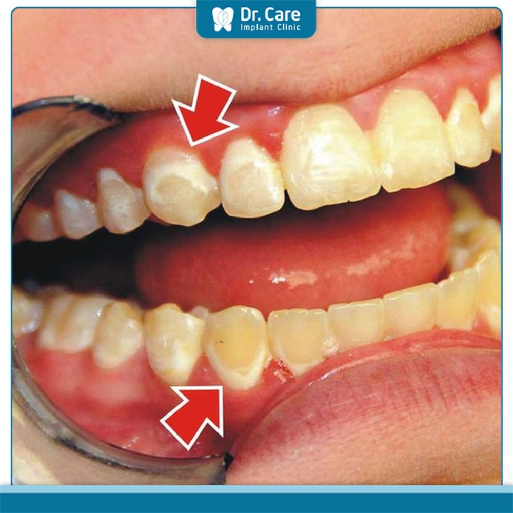 Dấu hiệu răng bị nhiễm tetracyclin