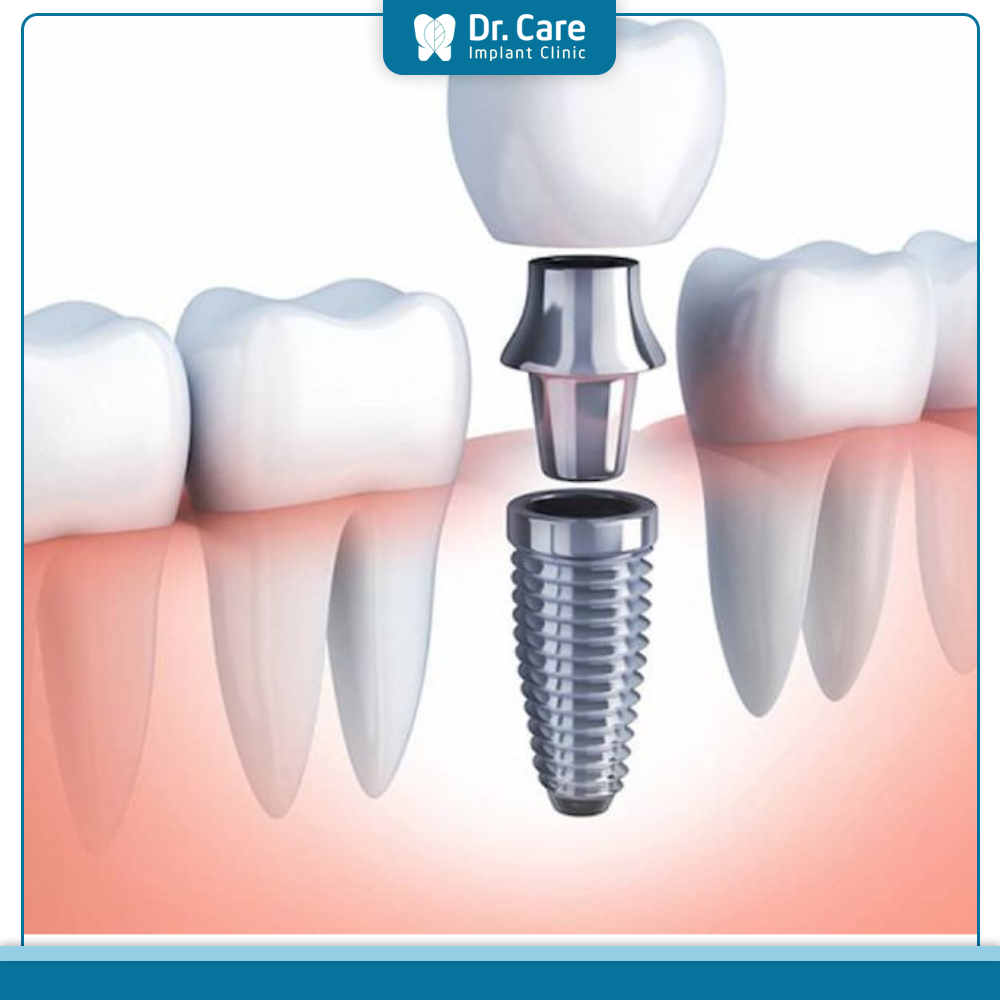 Phục hình răng sứ trên Implant