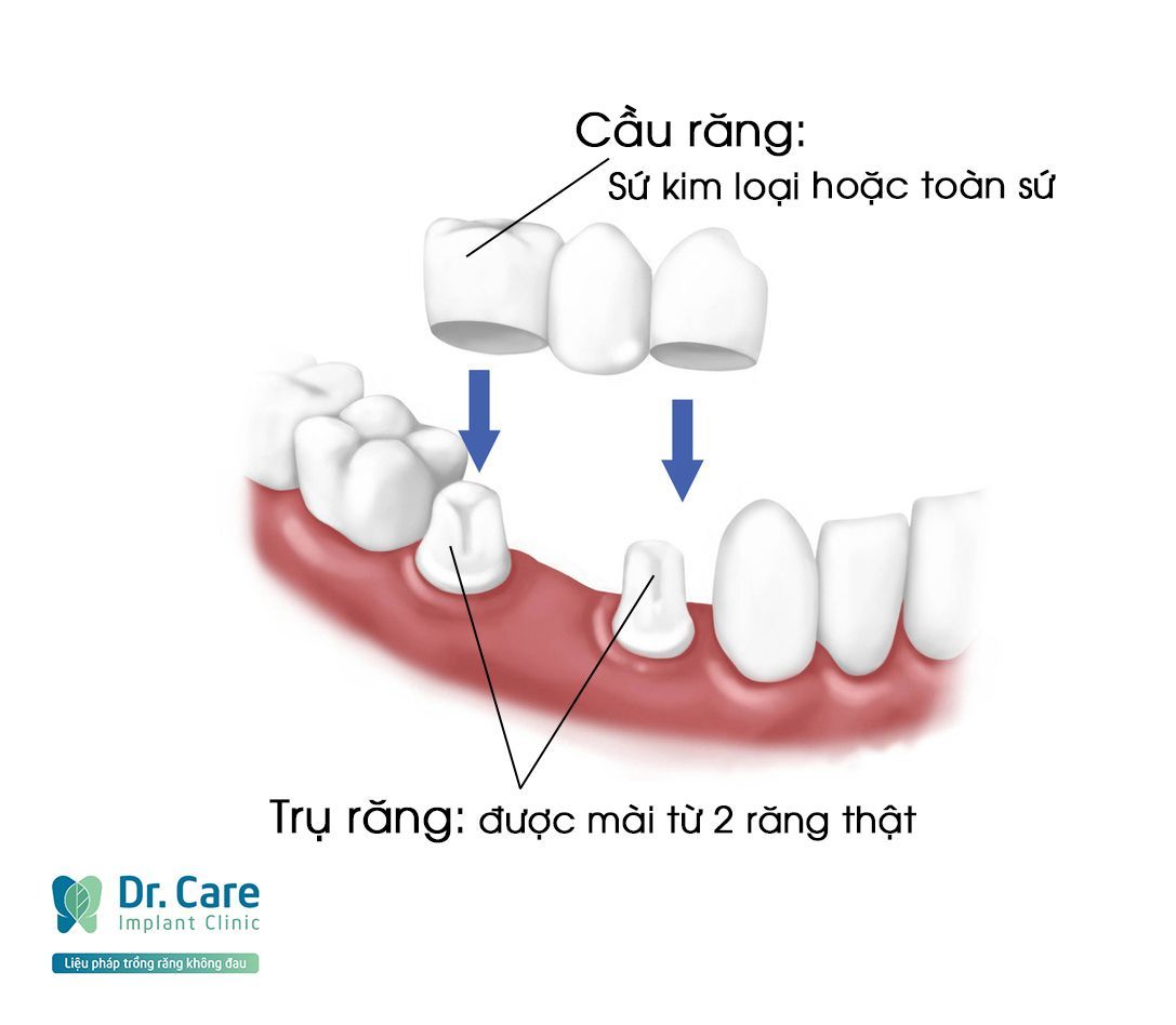 trồng răng implant cho người già