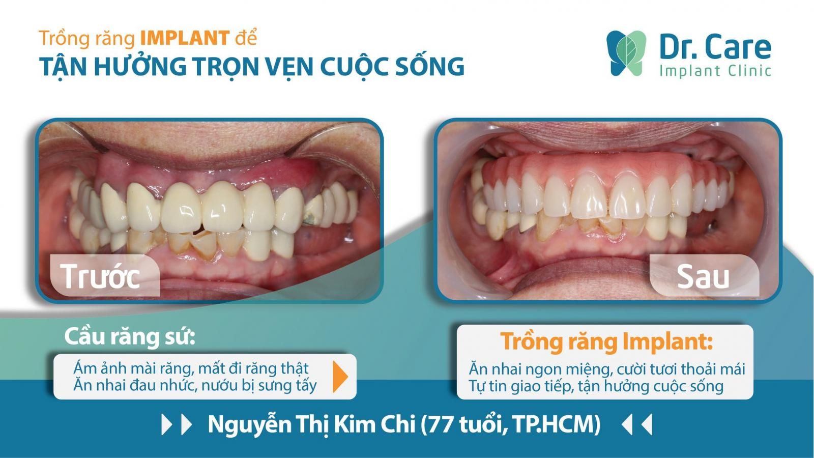 Trồng răng implant cho người già