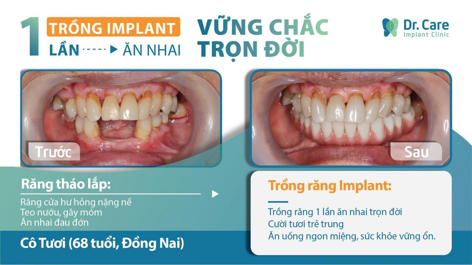 Trồng răng implant cho người già