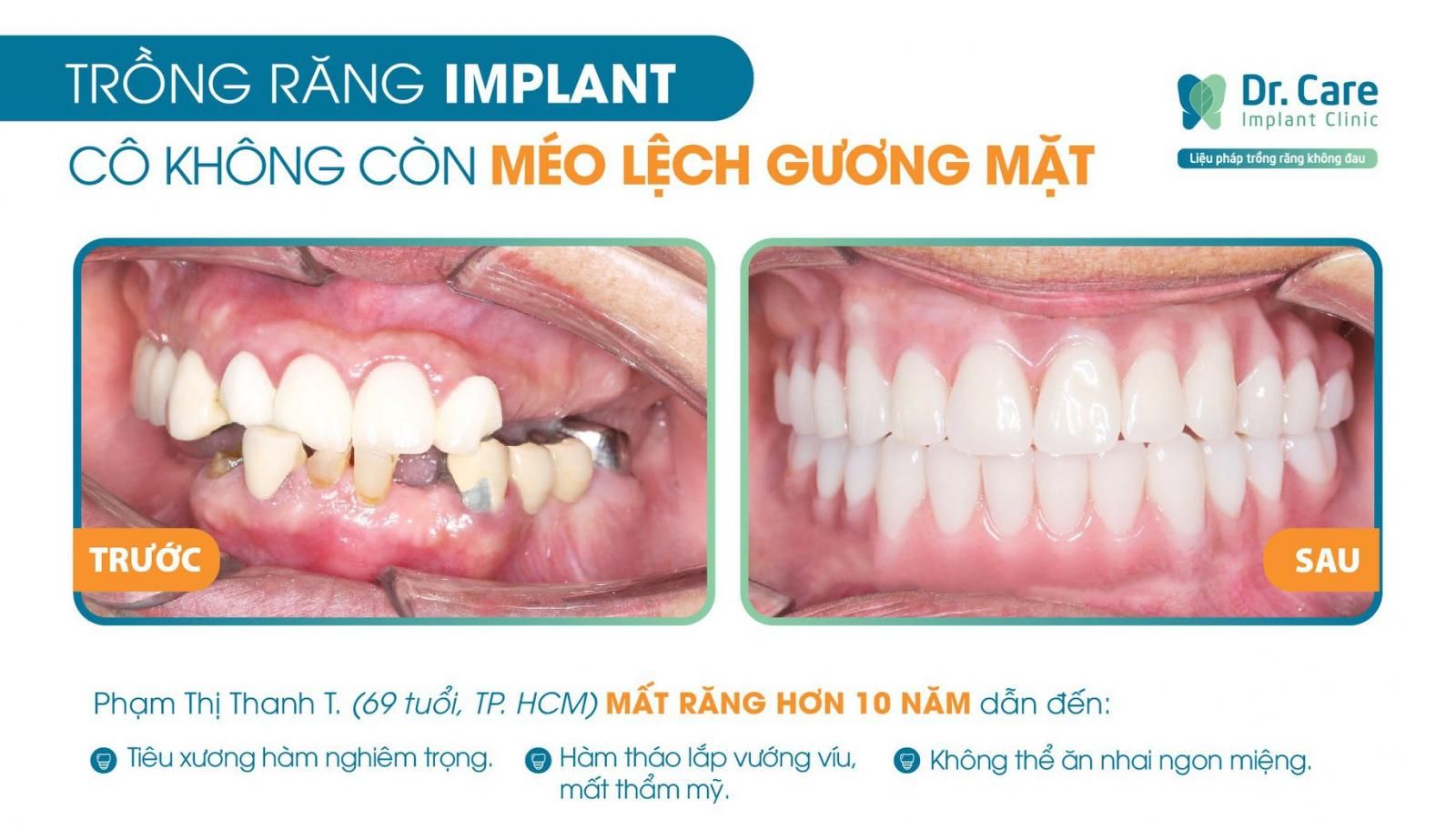 Trồng răng implant cho người già