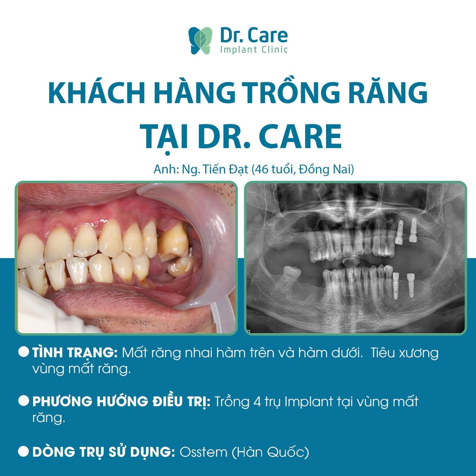 Ưu điểm vượt trội của phương pháp cấy ghép Implant khi trồng răng nhai 