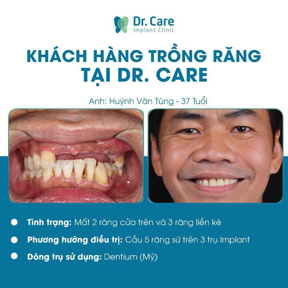 Trồng răng Implant khi mất 1 vài răng