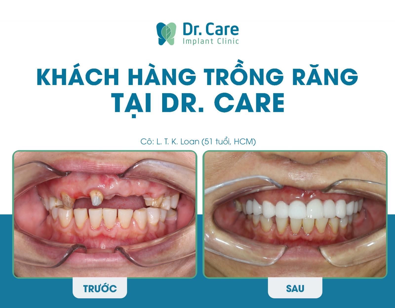 Mất răng bao lâu nên trồng răng Implant?