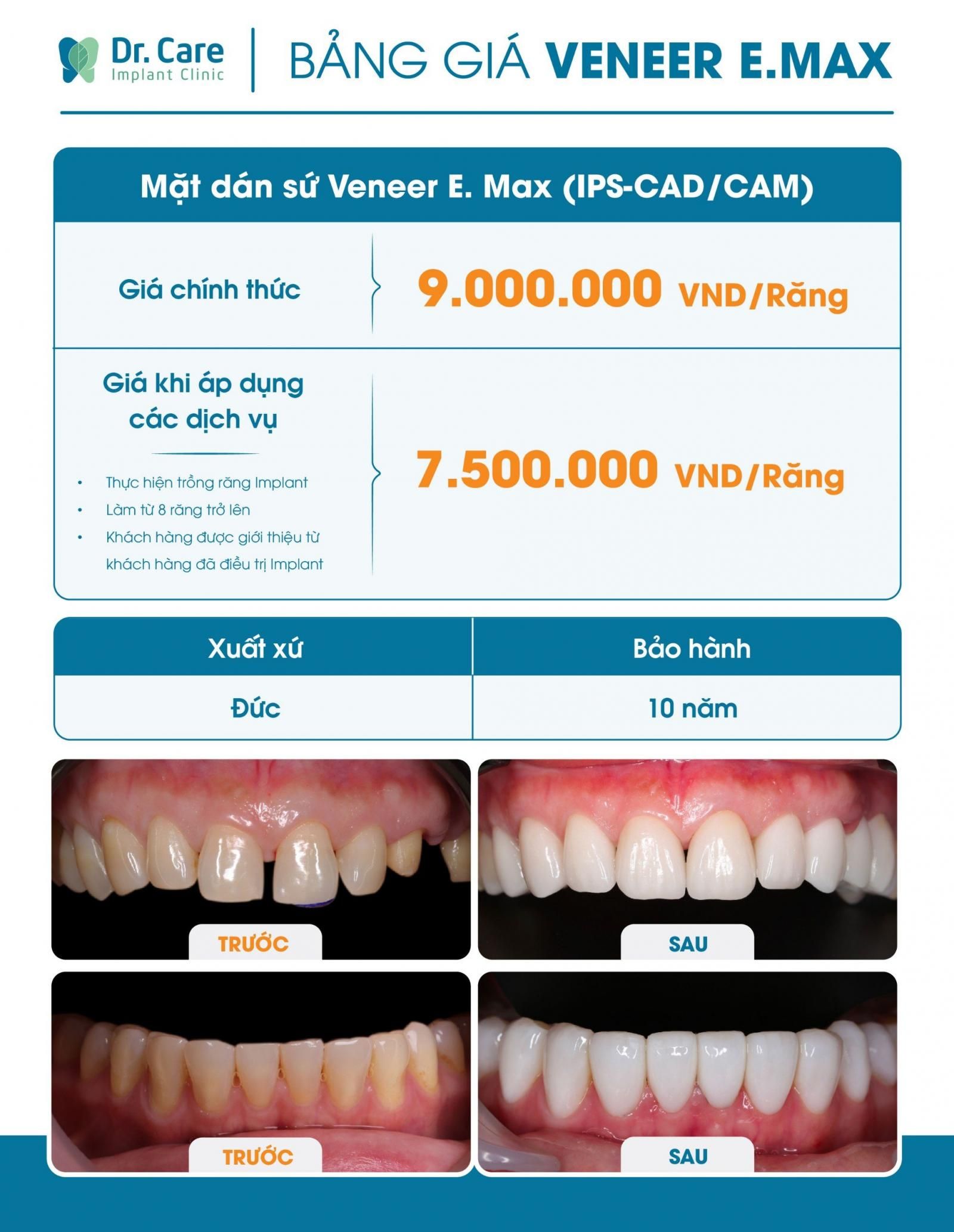 Bảng giá dán sứ Veneer tại Nha khoa Dr. Care tham khảo