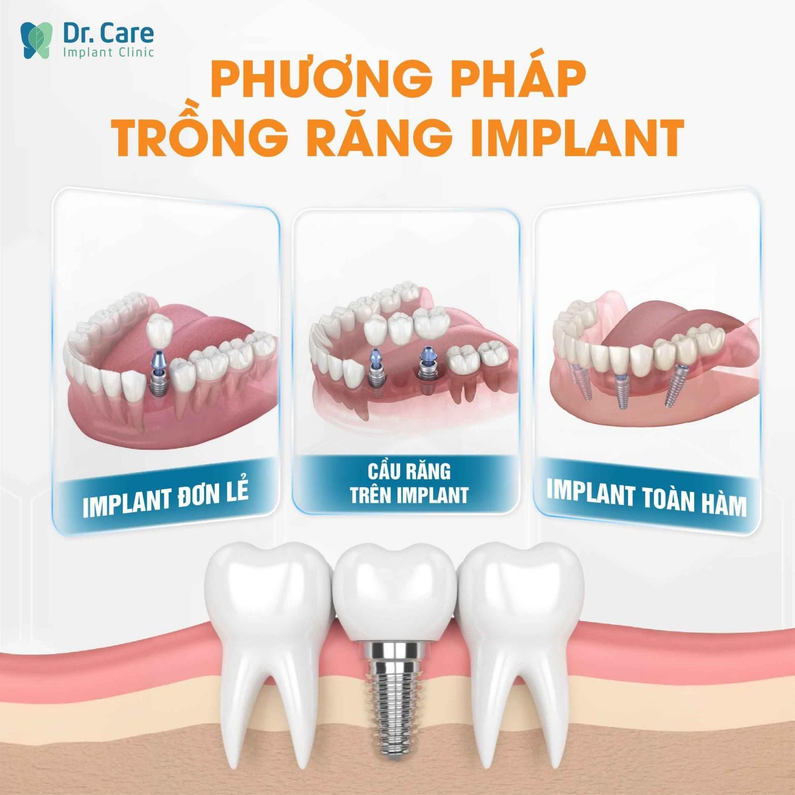 Trồng răng Implant (Cấy ghép Implant) là gì?