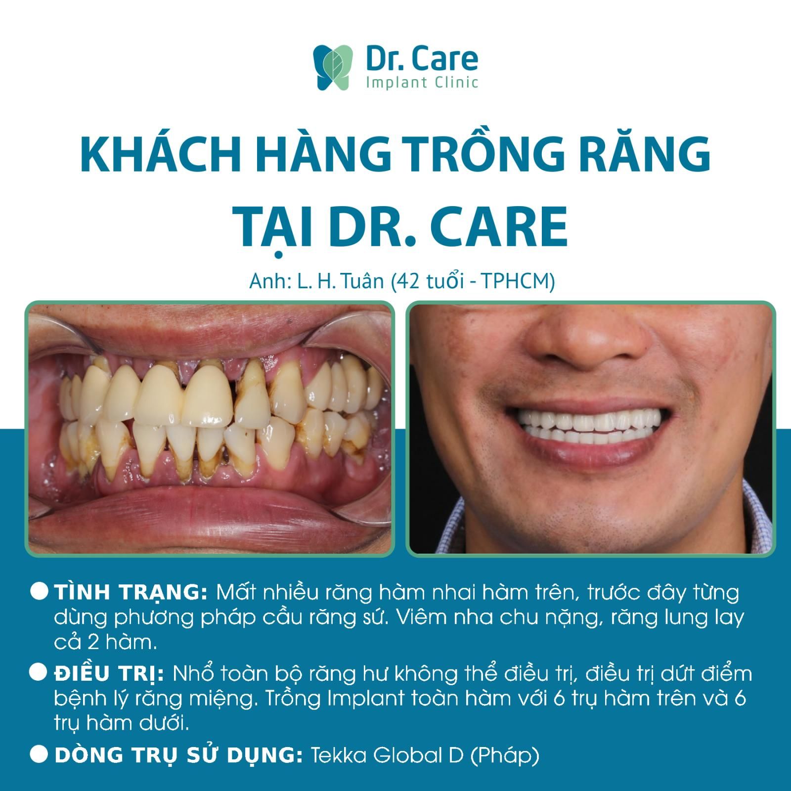 Trồng răng Implant cho răng bị mất do viêm lợi chảy máu chân răng