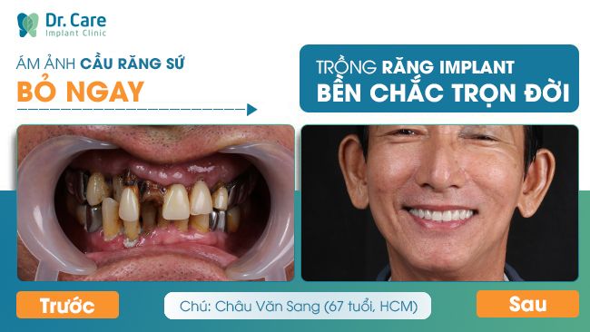 8 Tác hại bọc răng sứ giá rẻ