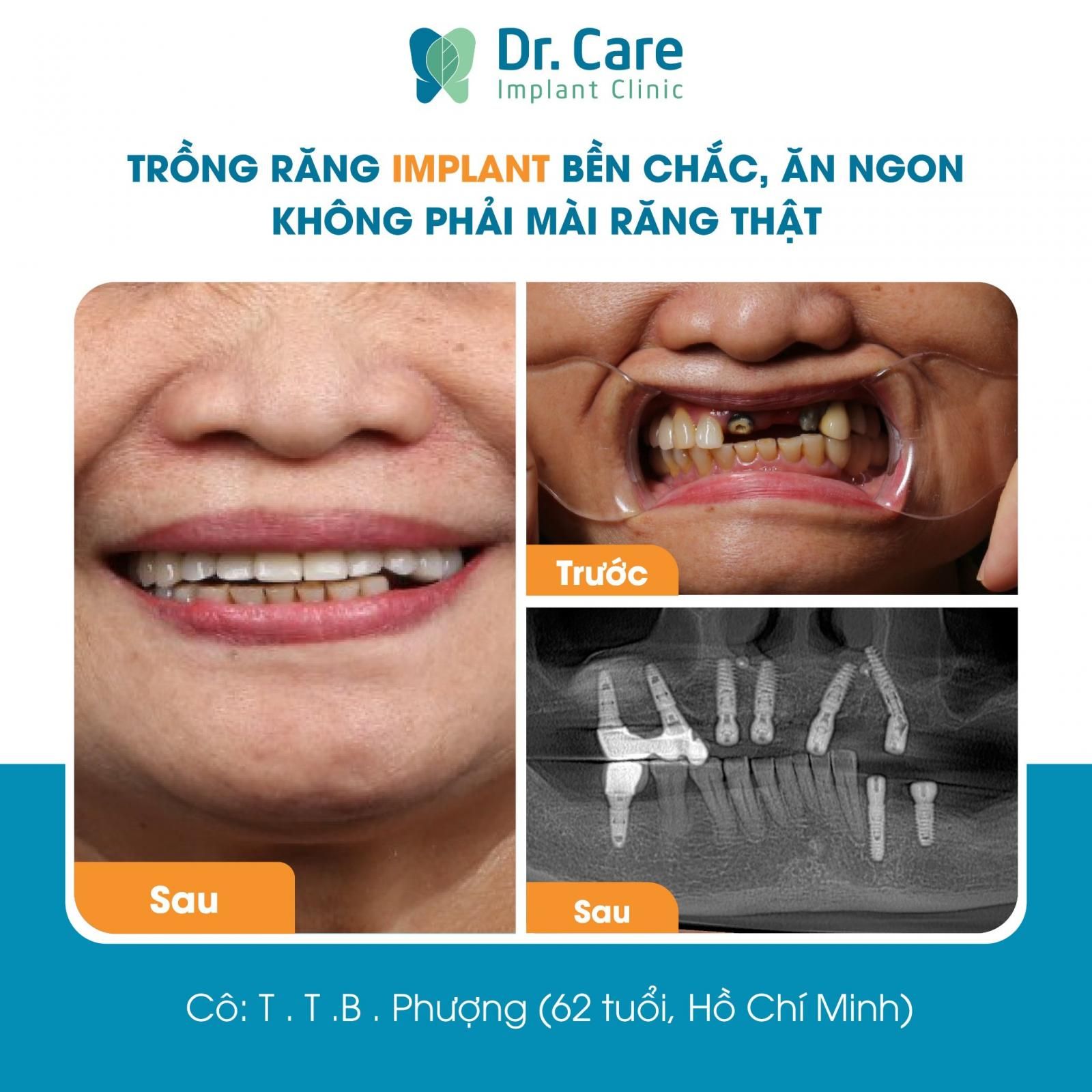 Bọc răng sứ thẩm mỹ bị hư có làm lại được không? 