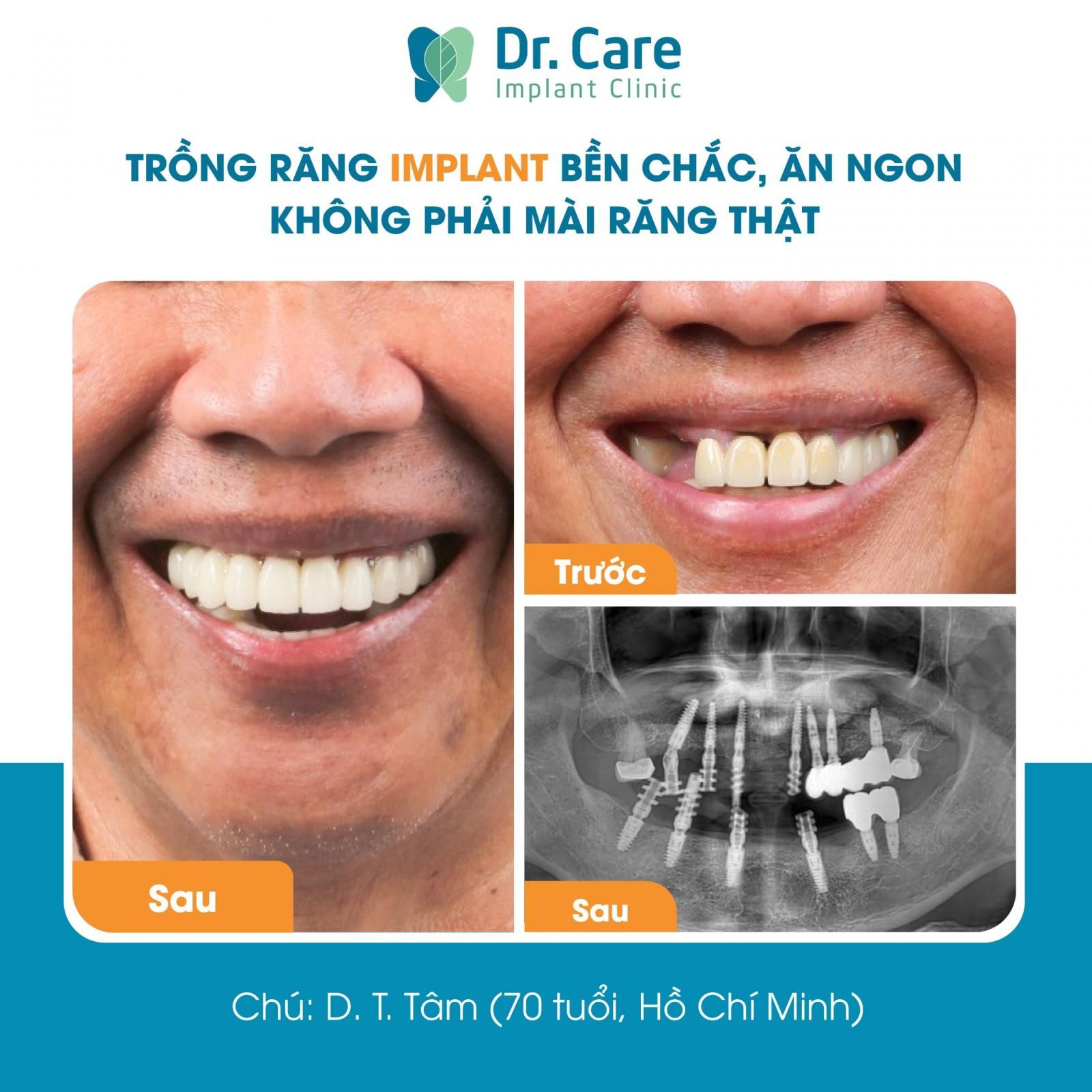 Thẩm mỹ đẹp, không đen viền nướu