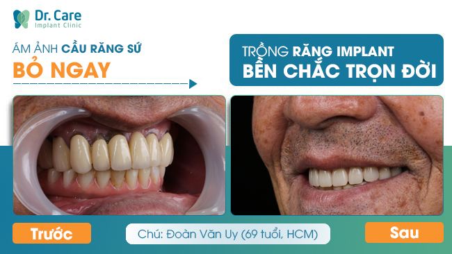 Trồng răng Implant khắc phục tình trạng răng cắn lưỡi khi dùng cầu răng sứ 