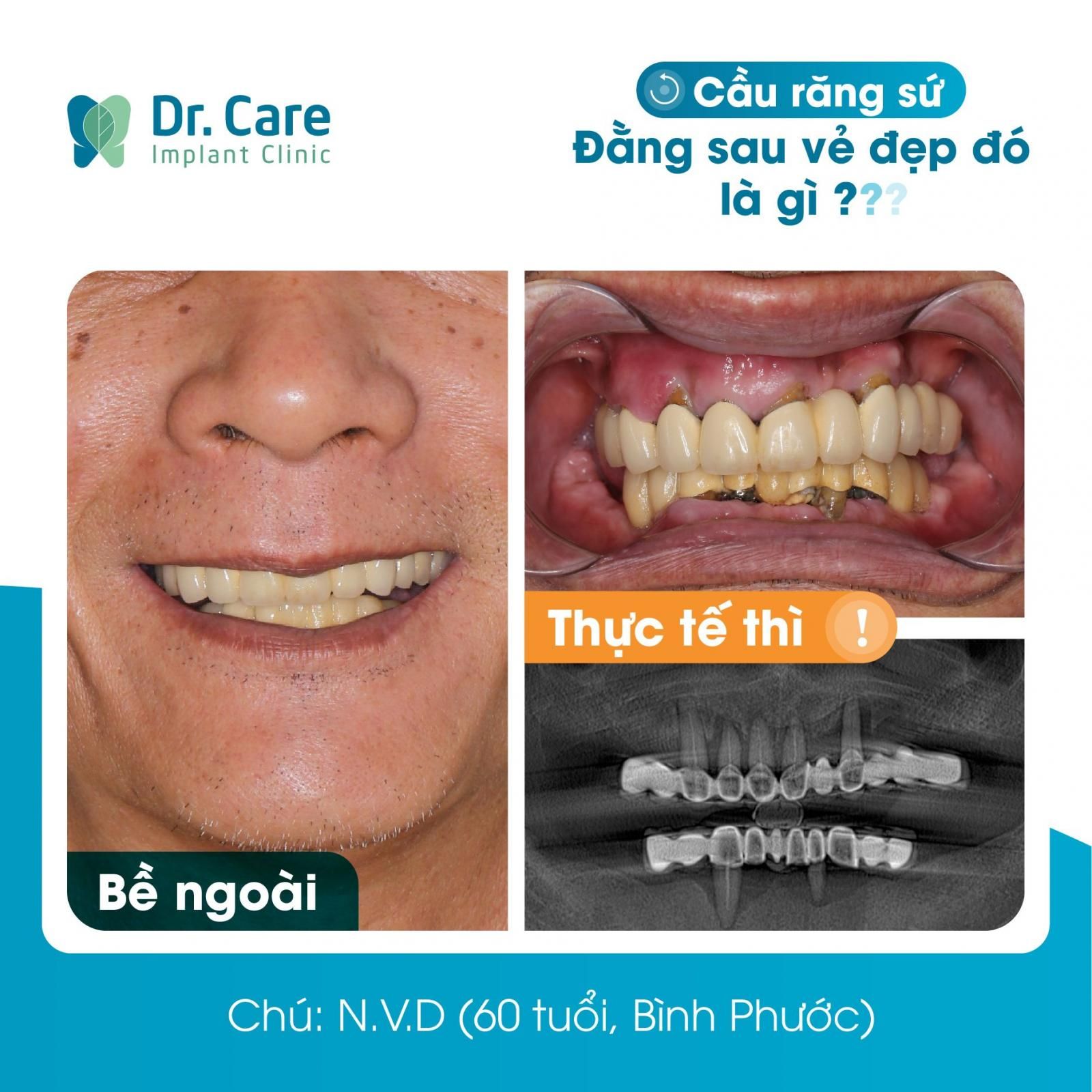 Bọc răng sứ thẩm mỹ bị hư ảnh hưởng như thế nào?