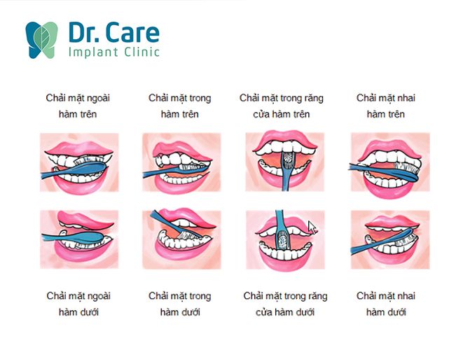 Làm thế nào để tránh bọc răng sứ bị lệch khớp cắn?