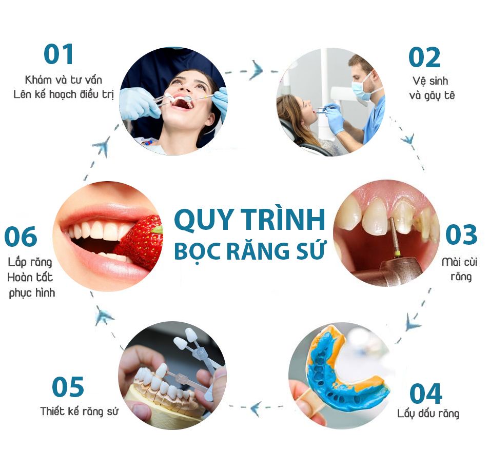 Quy trình bọc răng sứ thẩm mỹ