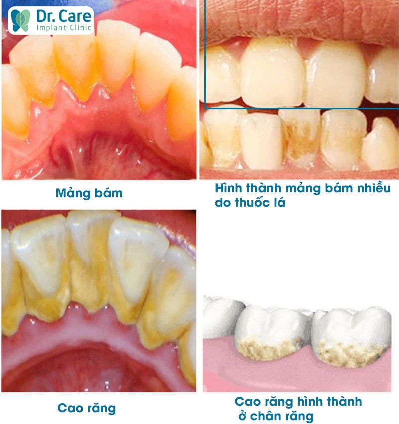 Phân biệt mảng bám và cao răng