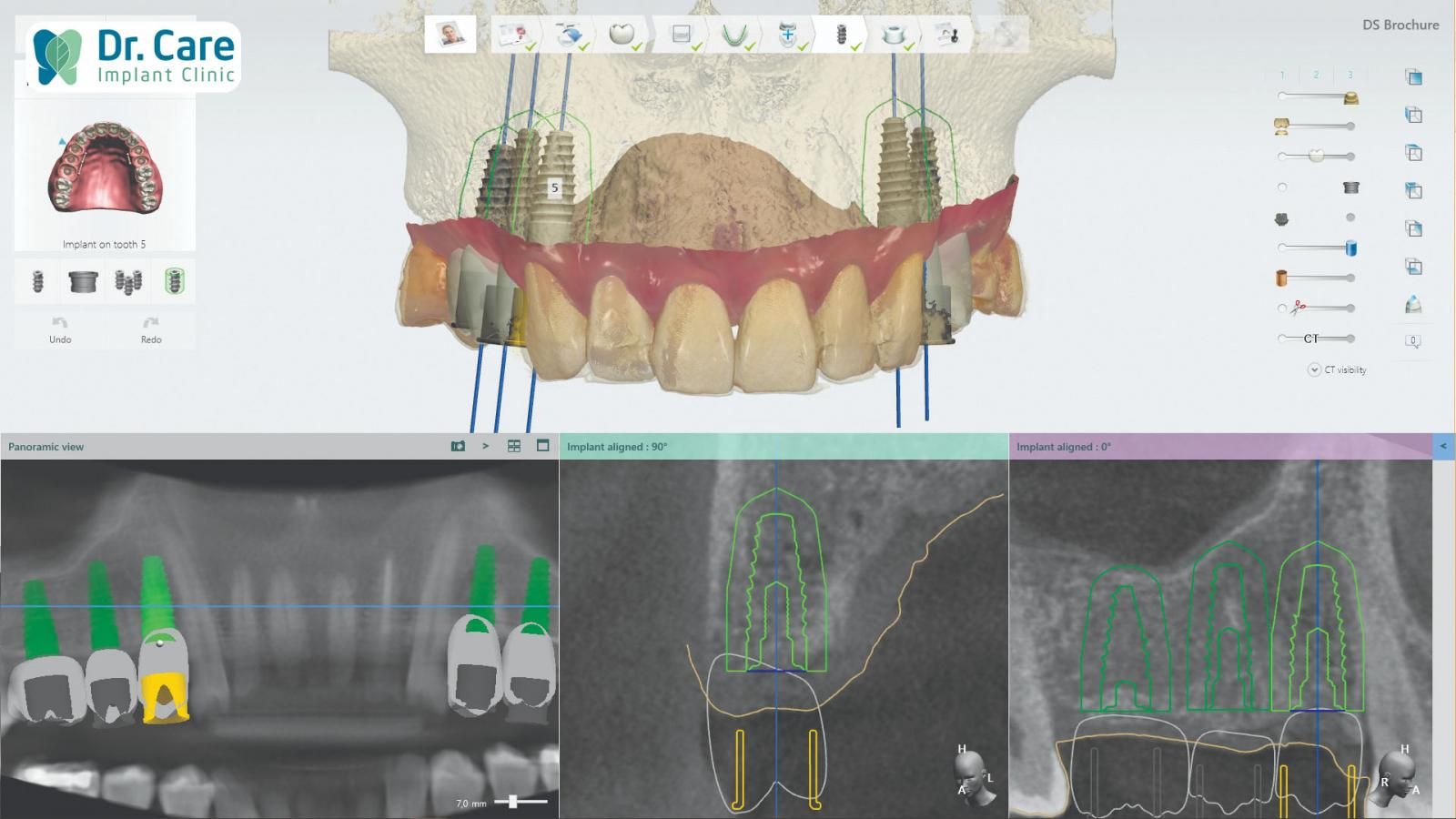 Ứng dụng CAD/CAM trong chế tác mão răng trên Implant