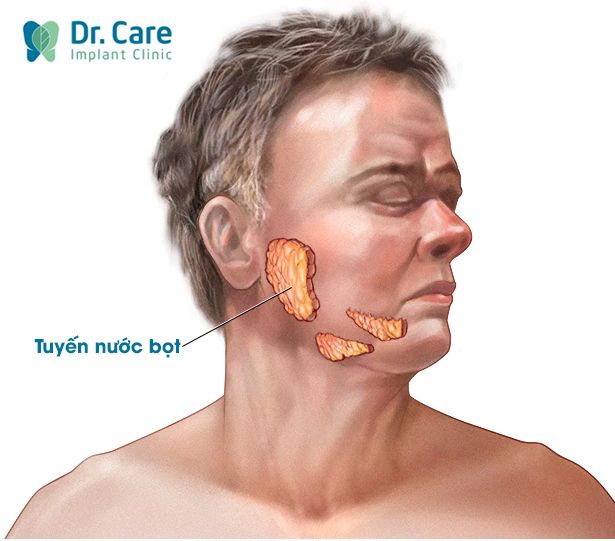 Viêm tuyến nước bọt