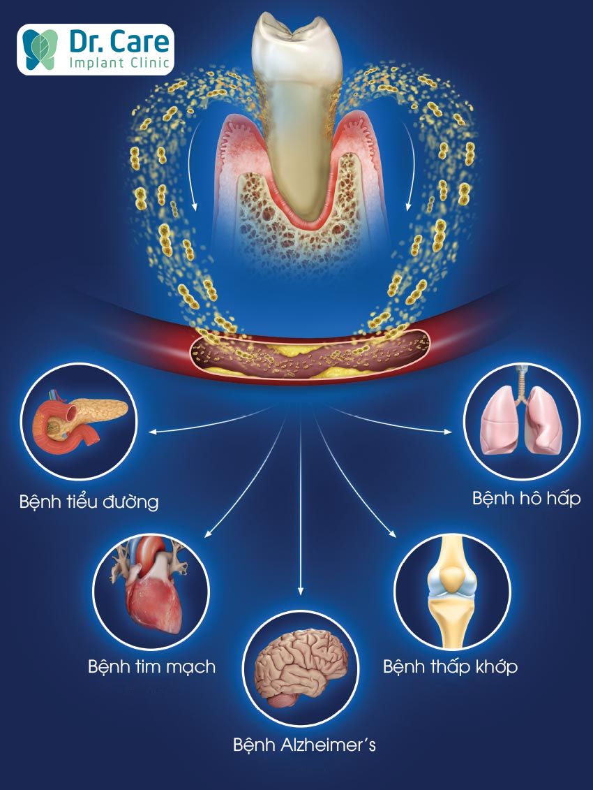 Tại sao đau răng lại gây nhiễm trùng máu?