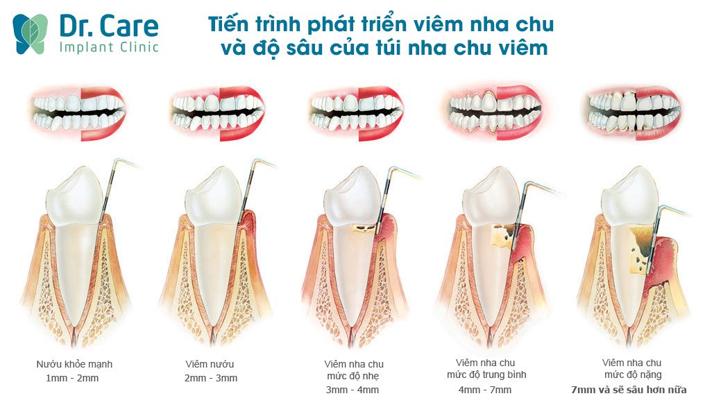 Viêm nha chu nặng