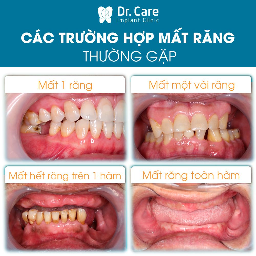 Số lượng răng sẽ ảnh hưởng rất nhiều đến việc trồng răng Implant có đau không