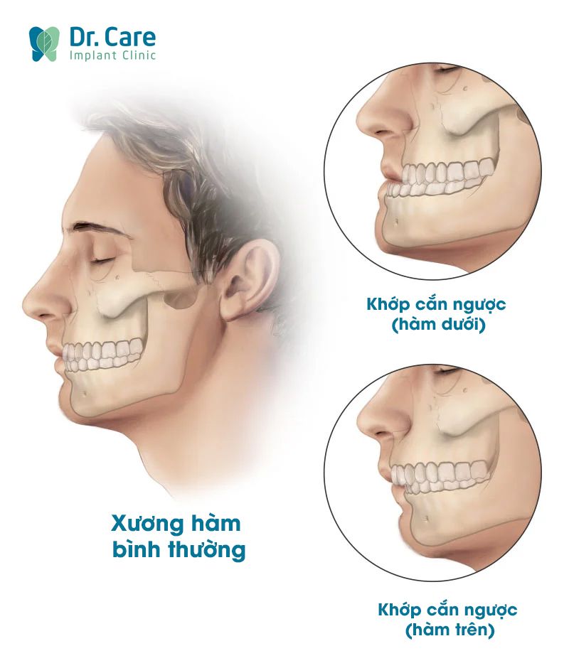 Nguyên nhân gây khớp cắn sâu