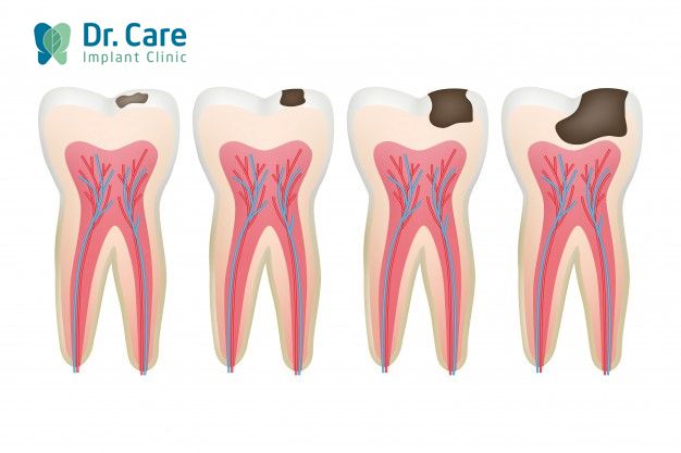 Các dấu hiệu nhận biết của sâu răng