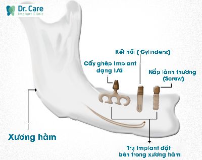  Endosteal (Implant trong màng xương)