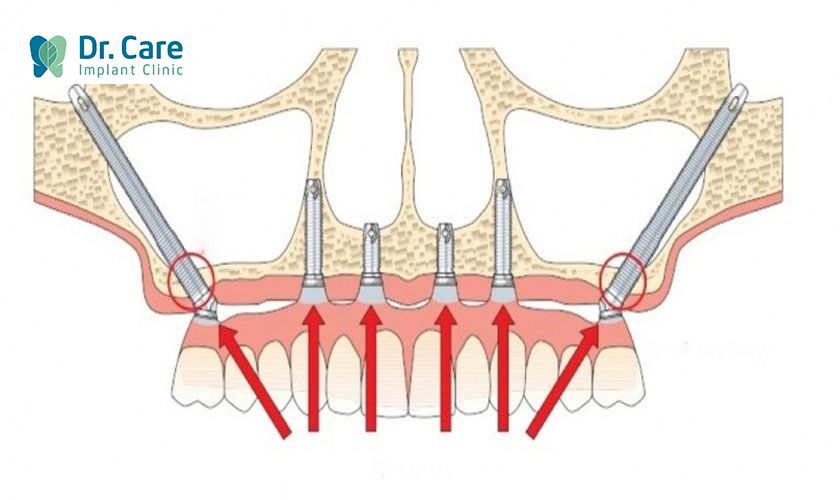 Zygomatic (Cấy ghép implant xương gò má) 