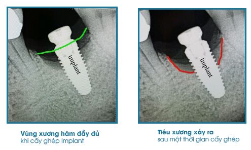 Biểu hiệu muộn của trồng răng Implant thất bại