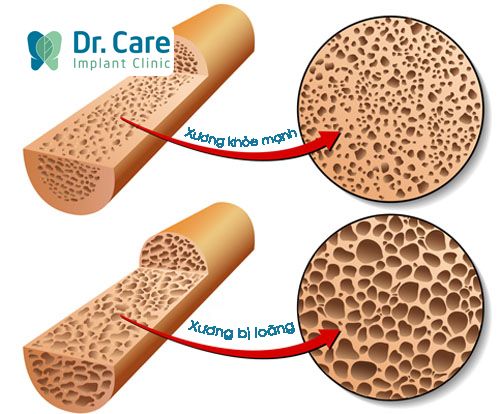 Những lưu ý quan trọng khi trồng răng Implant cho người thiếu canxi