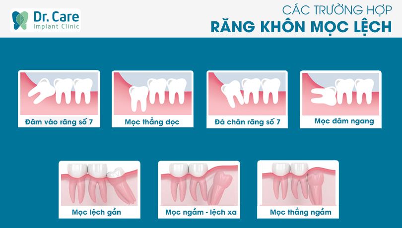 Nướu sưng do răng khôn mọc sai vị trí