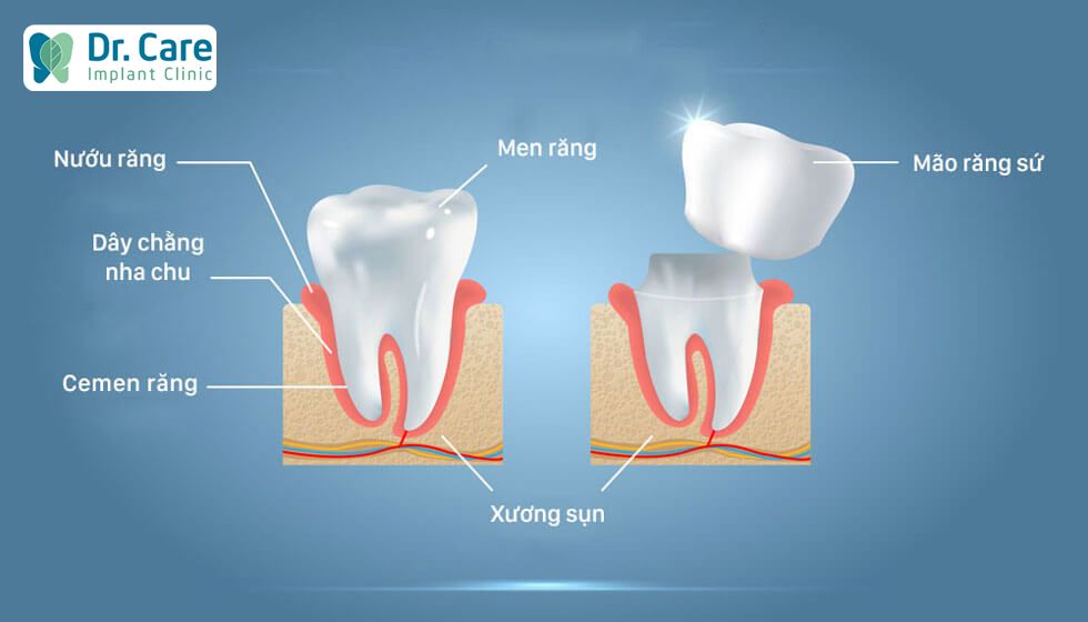 Bọc răng sứ là gì