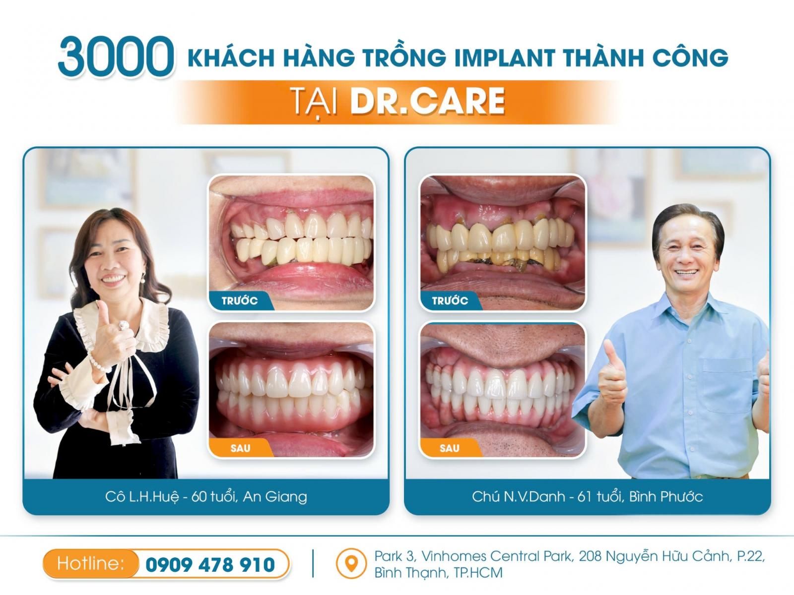 Hình ảnh trước và sau khi áp dụng liệu pháp trồng răng Implant không đau tại Dr. Care của Cô Chú