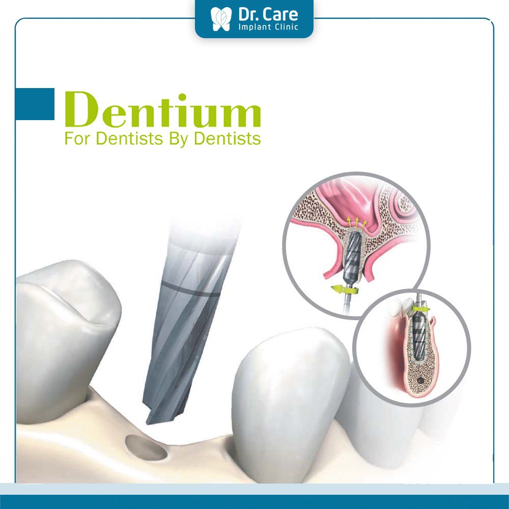 trụ implant dentium hàn quốc