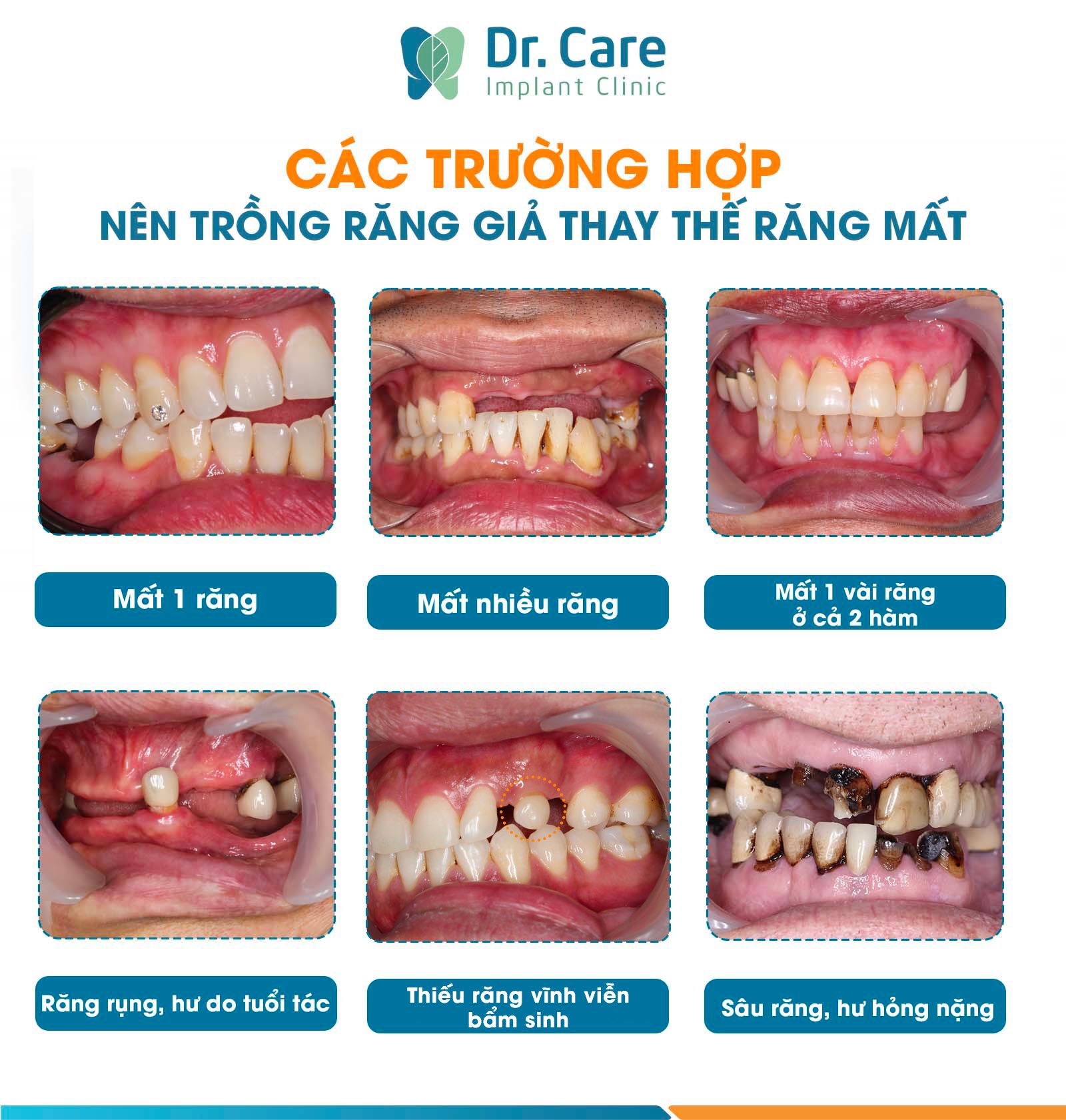 Các trường hợp cần làm răng giả