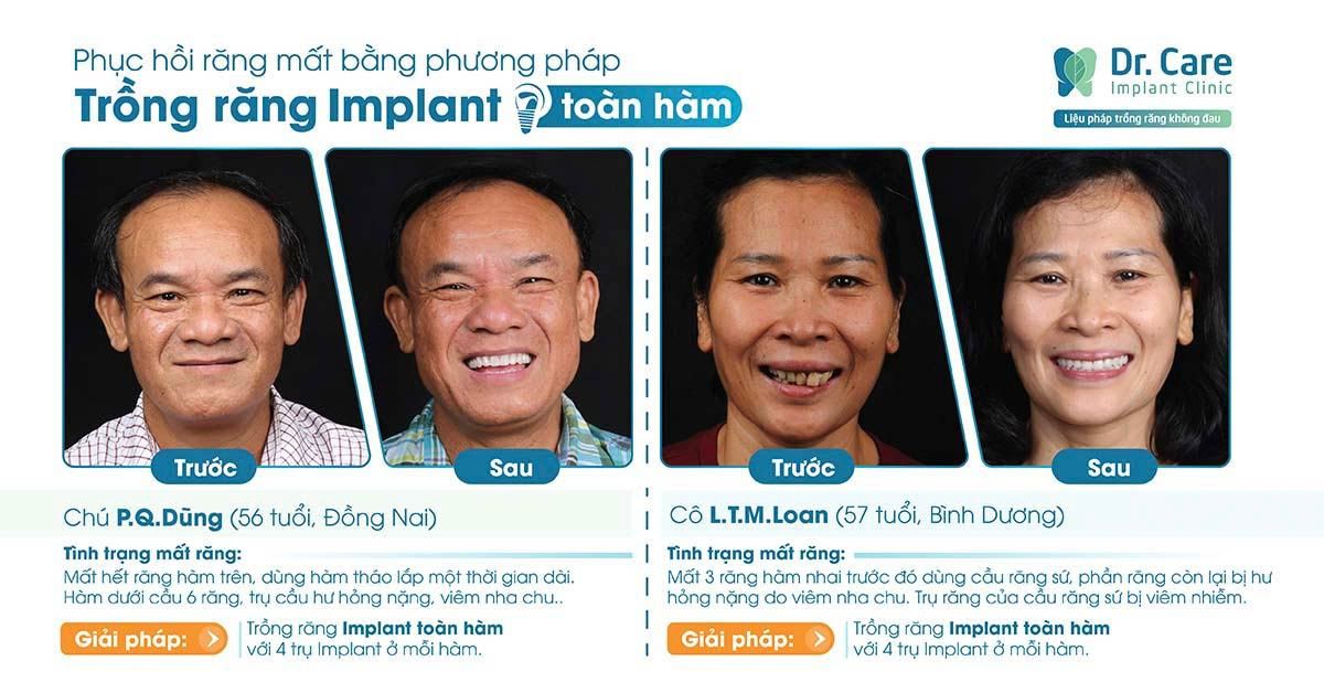 Tại sao phải tuân theo quy trình trồng răng Implant tiêu chuẩn?