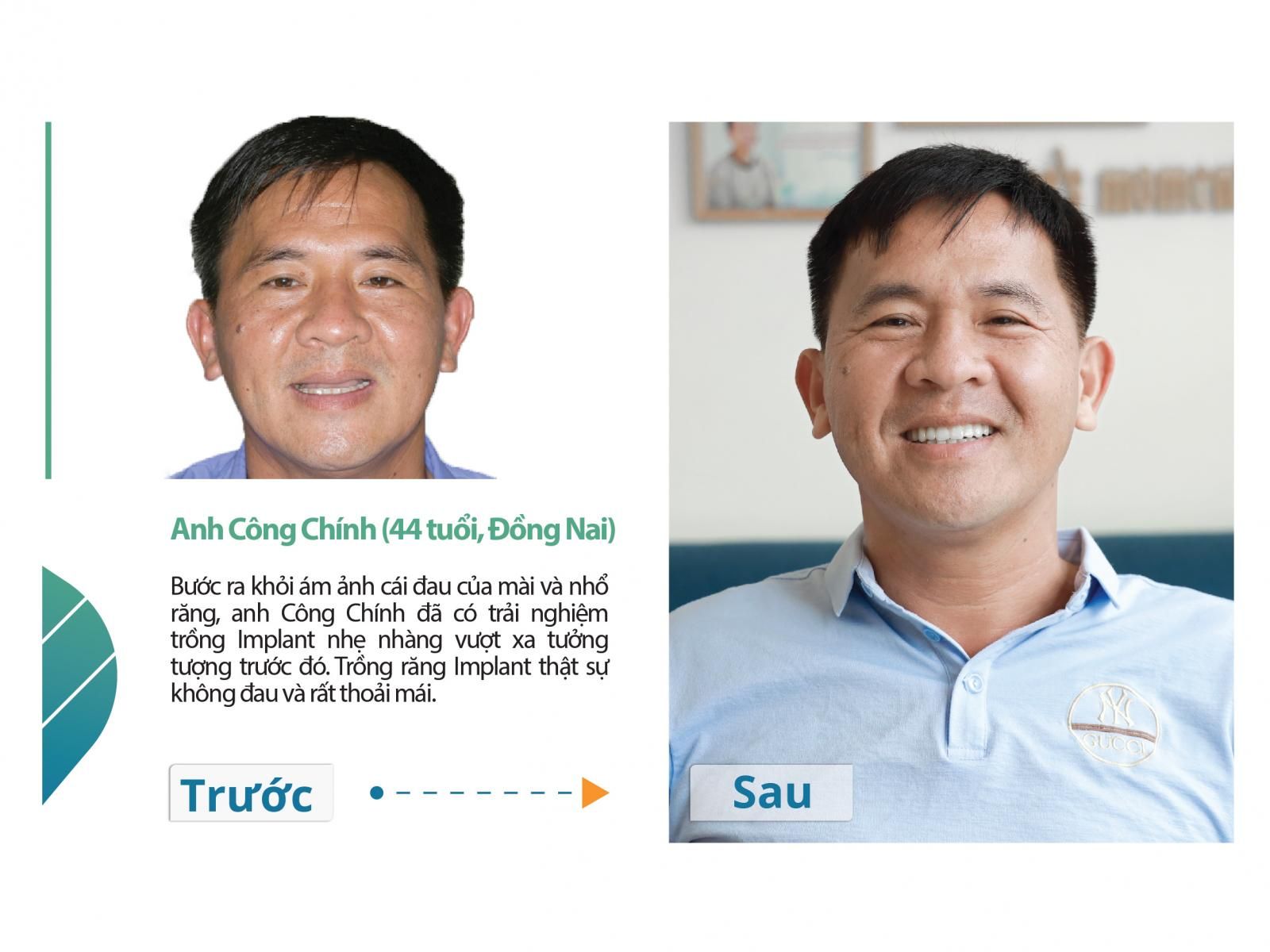 Dr. Care - Implant Clinic: Liệu pháp trồng răng không đau với 12 bước chẩn y khoa