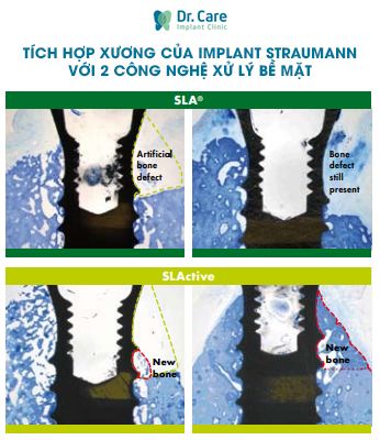 Trụ Implant nào tích hợp xương tốt nhất?