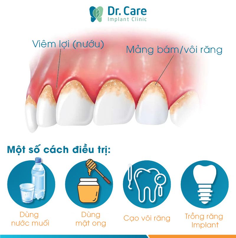 Hướng dẫn cách điều trị viêm lợi an toàn, hiệu quả