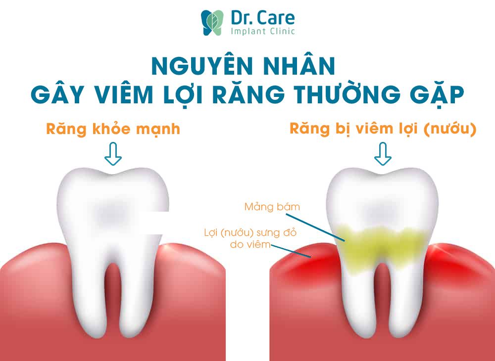 Nguyên nhân gây nên tình trạng viêm lợi