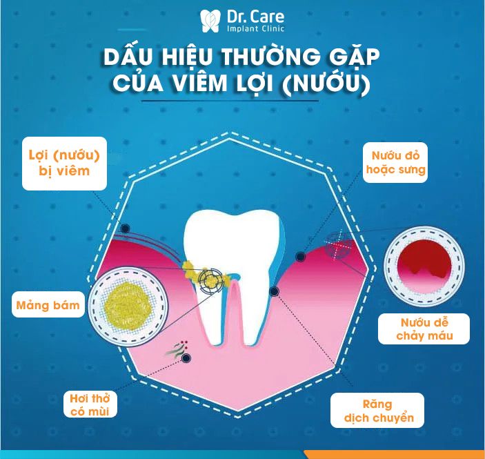 Dấu hiệu viêm lợi (viêm nướu răng)