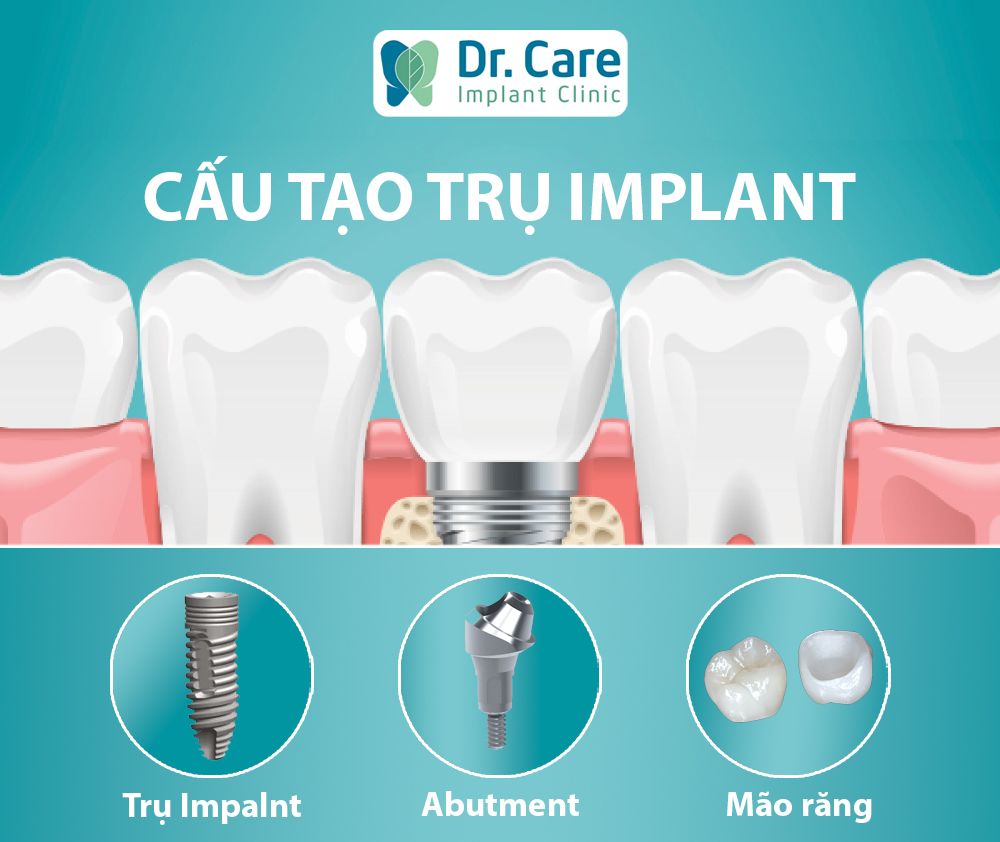 Cấu tạo trụ Implant gồm những gì?