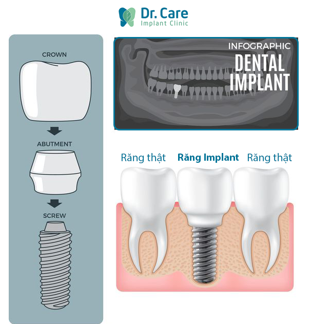 Vai trò của trụ Implant trong cấy ghép Implant