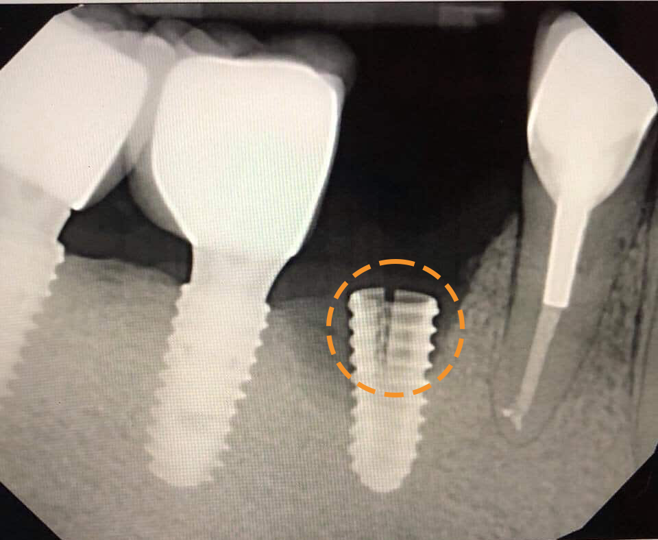 Trụ Implant giá rẻ dễ tét, gãy trong quá trình sử dụng